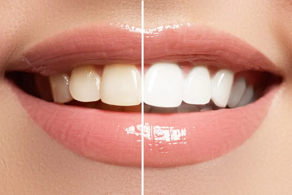 A smiling person showing off their freshly whitened teeth after a lazer treatment Windsor
