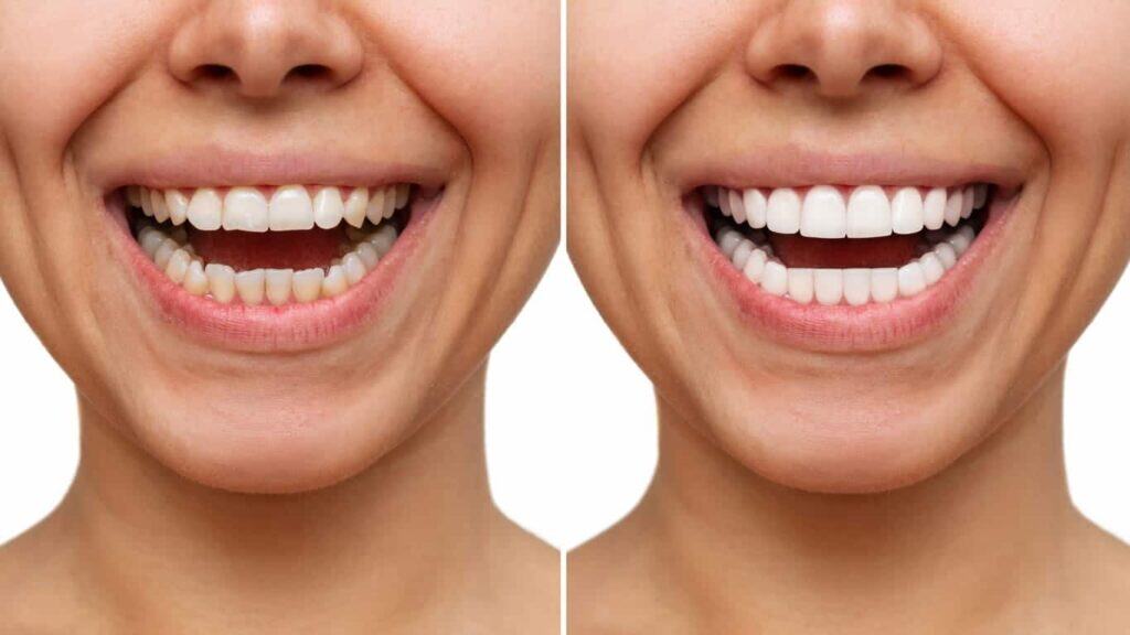 Comparison of teeth before and after lazer whitening, illustrating the effectiveness of the procedure Windsor