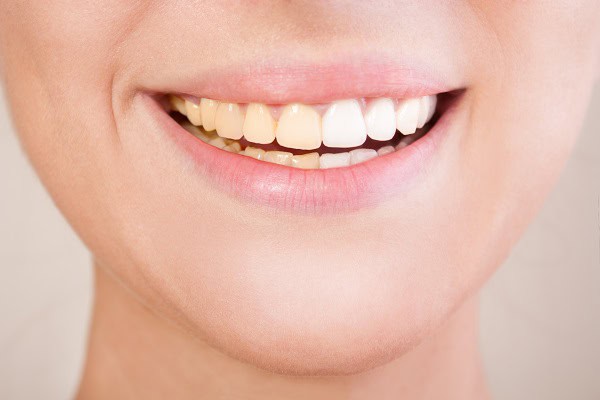 Side-by-side comparison of teeth before and after a lazer whitening session. Windsor