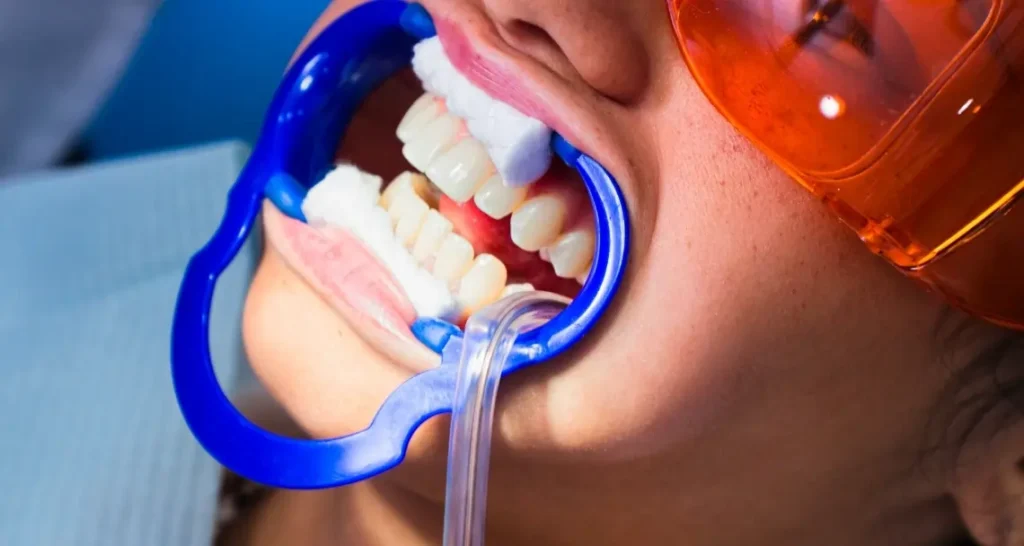 How Often Do I Need Lazer Teeth Whitening Treatment Windsor