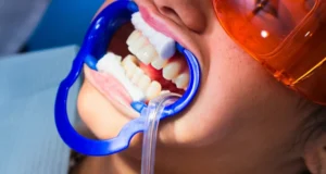 How Often Do I Need Lazer Teeth Whitening Treatment Windsor