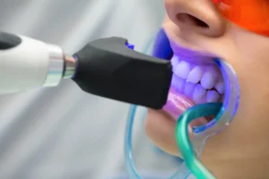 Will I See Immediate Results from Lazer Teeth Whitening Windsor